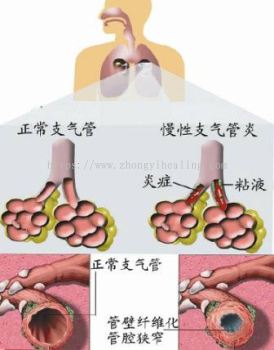 慢型支气管炎