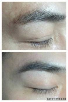 Natural Hair inplant - Man Eyebrow 