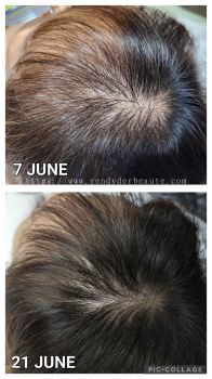 Peptide hair restorative treatment 
