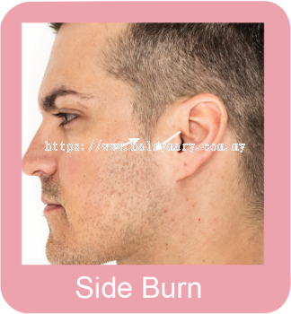 Permanent hair removal side burn
