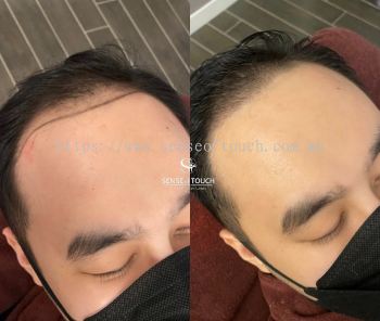 Sense Of Touch Hair Loss Treatment Testimony / 面对脱发问题 & 生发护理