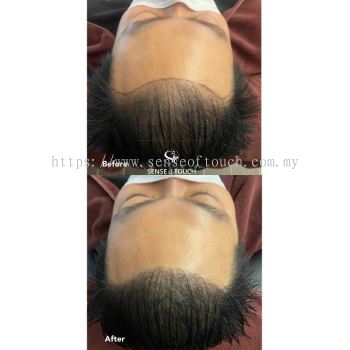 Sense Of Touch Hair Loss Treatment Testimony / 面对脱发问题 & 生发护理