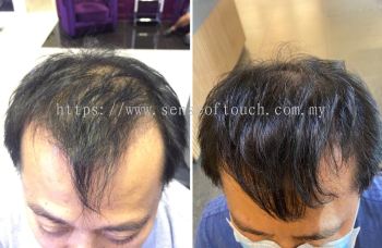 Sense Of Touch Hair Loss Treatment Testimony / ѷ & 