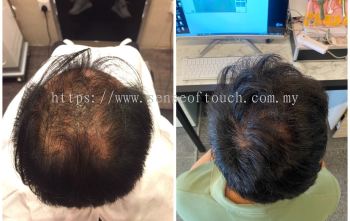 Sense Of Touch Hair Loss Treatment Testimony / ѷ & 