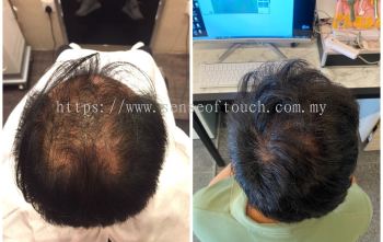 Sense Of Touch Hair Loss Treatment Testimony / 面对脱发问题 & 生发护理