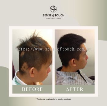 Sense Of Touch Hair Loss Treatment Testimony / ѷ & 