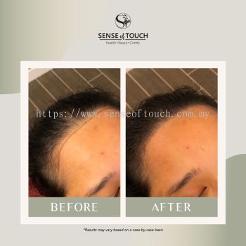 ST Hair Growth Scalp Treatment / ͷ