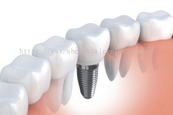 Dental Implants ֲ