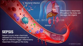 Sepsis