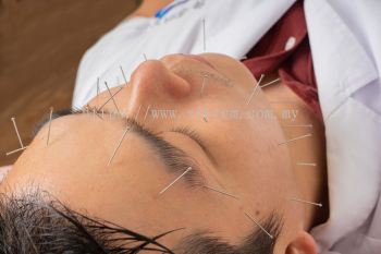 FACIAL REJUVENATION ACUPUNCTURE+FACIAL GUA SHA(Buy 10 free 3) - Sia Traditional Chinese Medicine