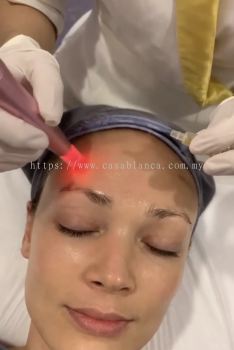 Platelet Rich Plasma (PRP) Facial