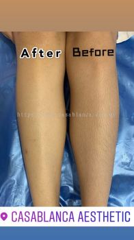 Diode Laser Hair Removal