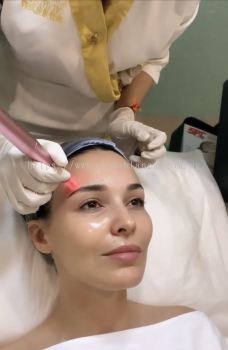 PRP Facial