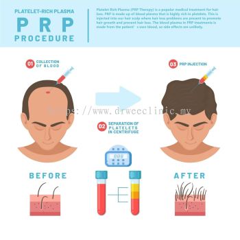 PRP Therapy Hair Loss