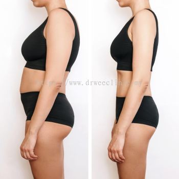 Fat Reduction Injections