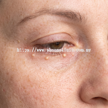 Milia removal
