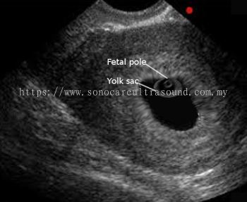 Confirmation Pregnancy Ultrasound Scan (include consultation)