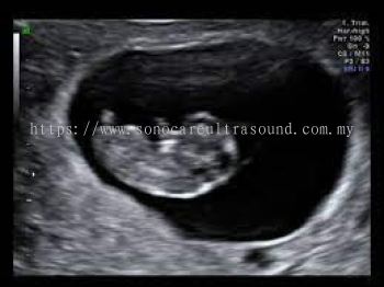 First Trimester Ultrasound