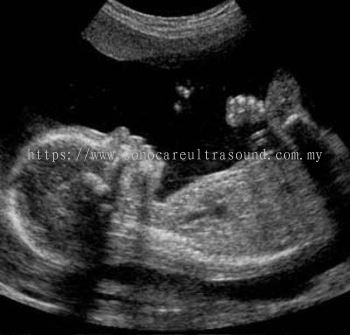 Ultrasound Imbasan Terperinci Trimester Kedua 