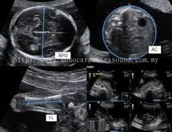 Ultrasound Pertumbuhan Trimester Ketiga