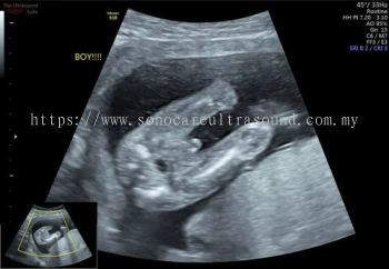 Fetal Gender Ultrasound Scan