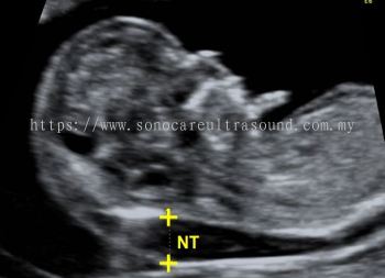 What is NT Scan for pregnancy? 