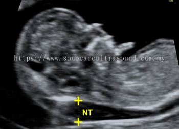 What is NT Scan for pregnancy?