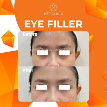 Eye Filler