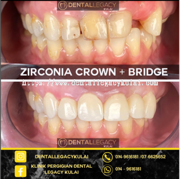 Full Zirconia Crown 