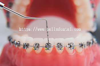 Braces (Self Ligation)