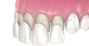 Dental Veneer