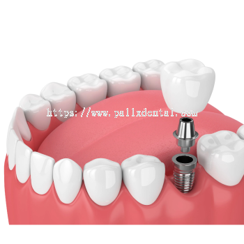 Dental Implant