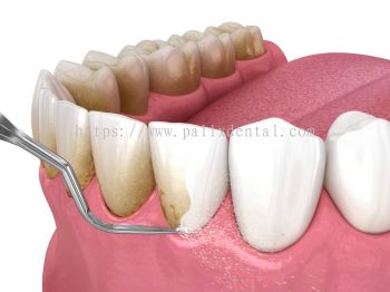 Scaling and Polishing / Oral Spa