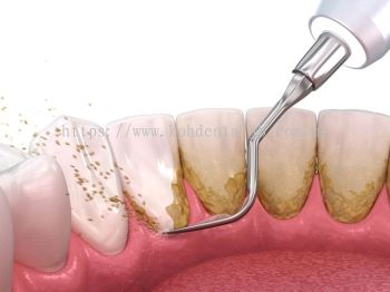 Scaling Treatment