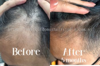 Anti-Hairfall Scalp Treatment