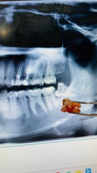 Minir Oral Surgery On 38