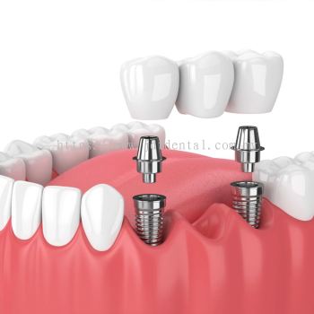 Crown Bridges Dentures