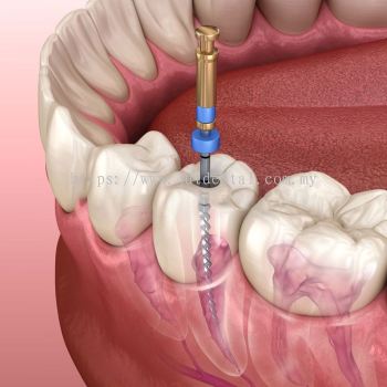 Root Canal Treatment