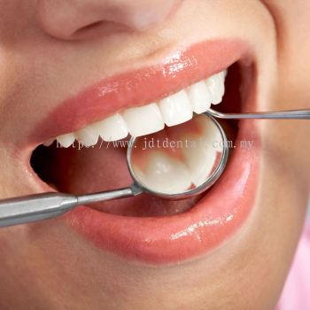 Dental Fillings