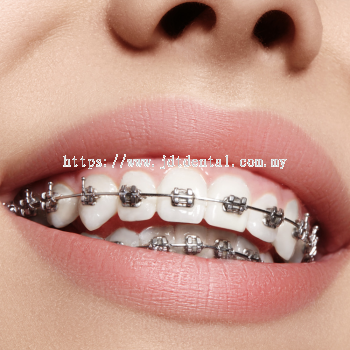 Orthodontic Treatment