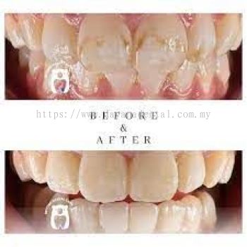 Fluorosis Dental Treatment