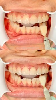 Whitening Dental Treatment