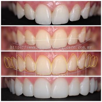 Dental Veneers 