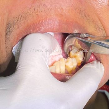 Dental Extraction