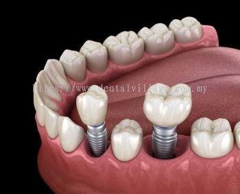 Dental Implant