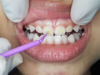 Fluoride Varnish