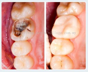 Composite Fillings