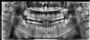 2D Orthopantomogram (OPG) X-Ray