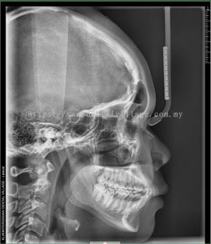 2D Lateral Cephalometric X-Ray