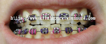 Braces (Conventional Braces)